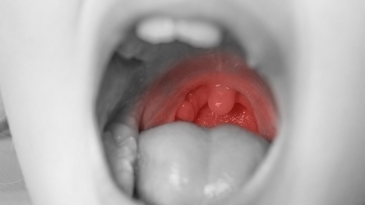 Oral Steroids After Tonsillectomy May Modestly Cut Kids’ Pain