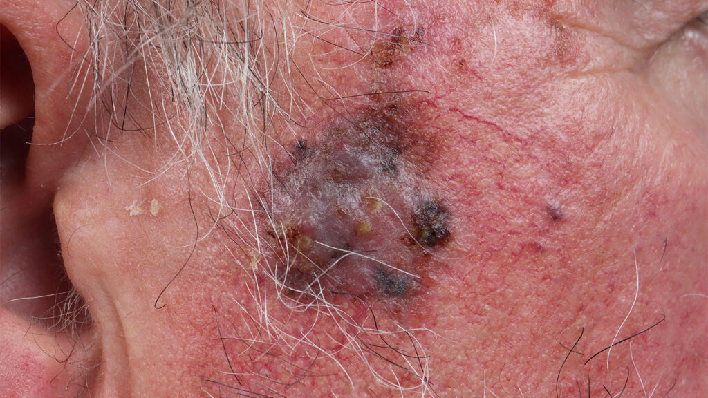 Twice-Rejected Melanoma Drug Gets Surprise Love From FDA Panel