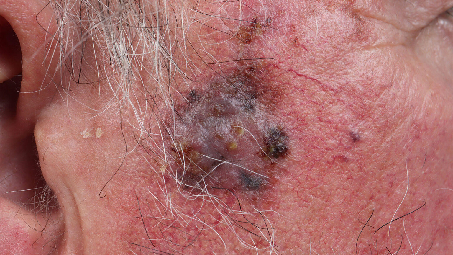 Twice-Rejected Melanoma Drug Gets Surprise Love From FDA Panel