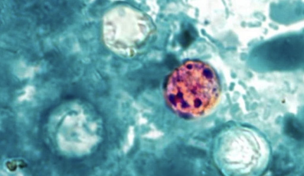 Patient counts in Cyclospora outbreak continue to increase