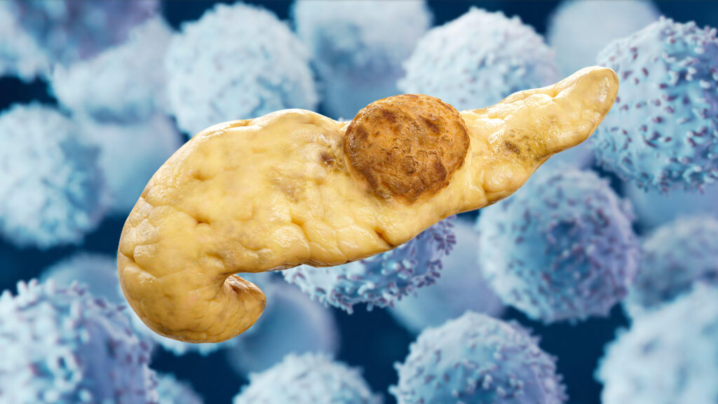 Pancreatic Cancer Vaccine Shows Interception Promise in High-Risk Patients