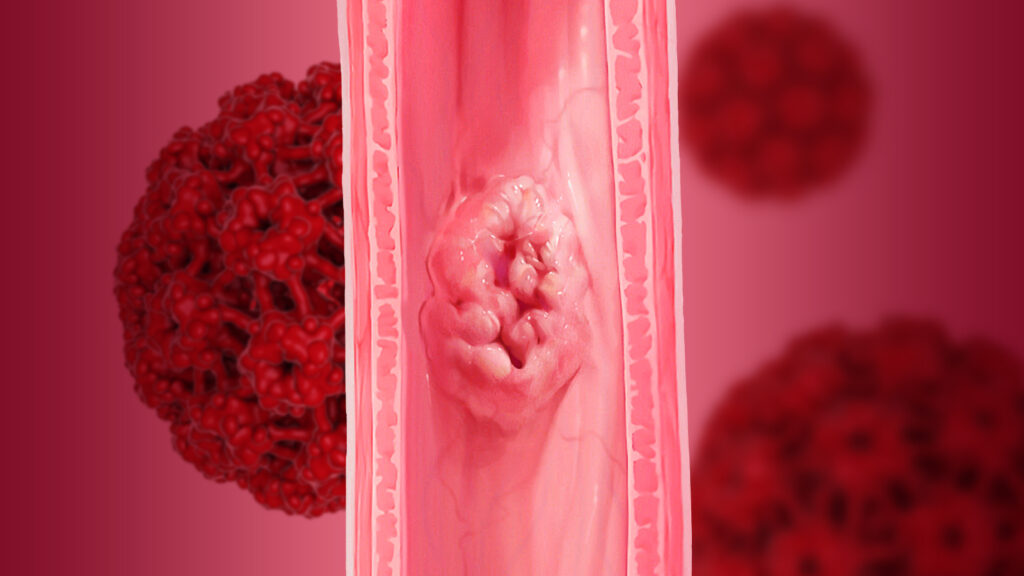 HPV Infection and Esophageal Cancer