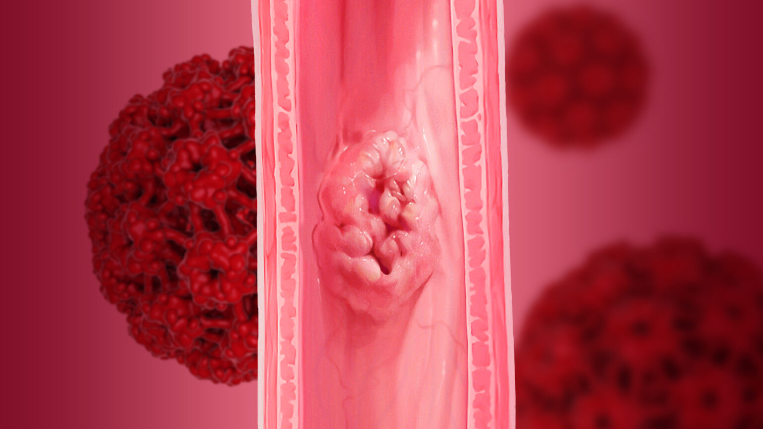HPV Infection and Esophageal Cancer