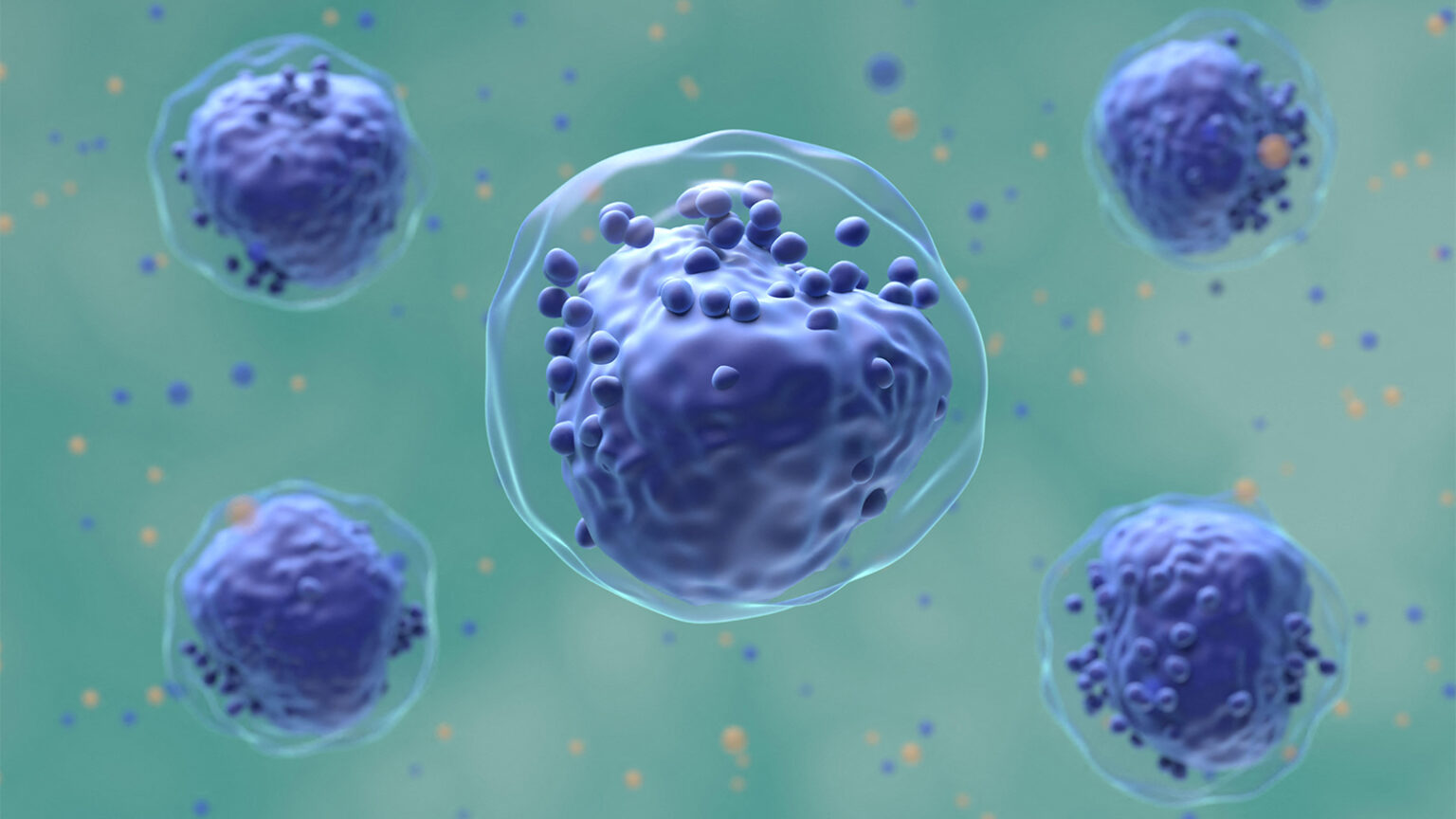 Liposomal Chemo Combination No Better Than Standard Induction in Pediatric AML
