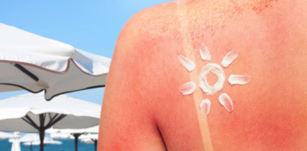 No safe tan: Why Canada’s sunburn problem keeps getting worse