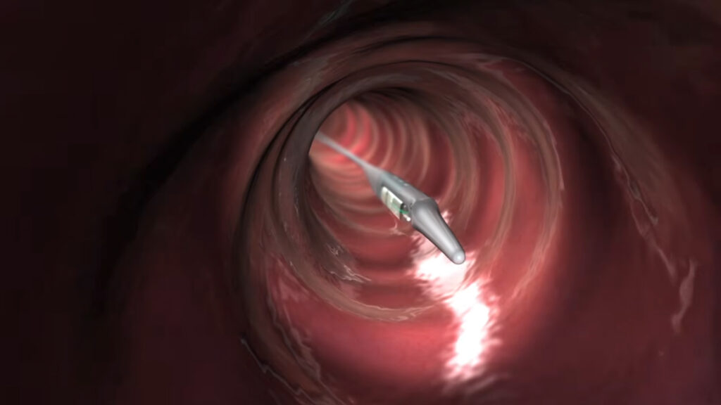 Medtronic Reflux Device Linked to 184 Serious Injuries, FDA Warns