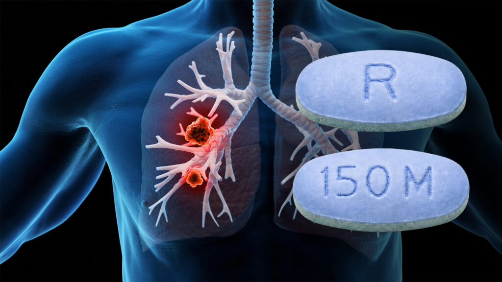 Groundbreaking Pancreatic Cancer Drug Shows Promise in Lung Cancer