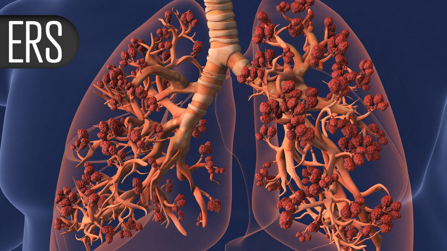 More Evidence Ties Microplastics to Lung Cancer