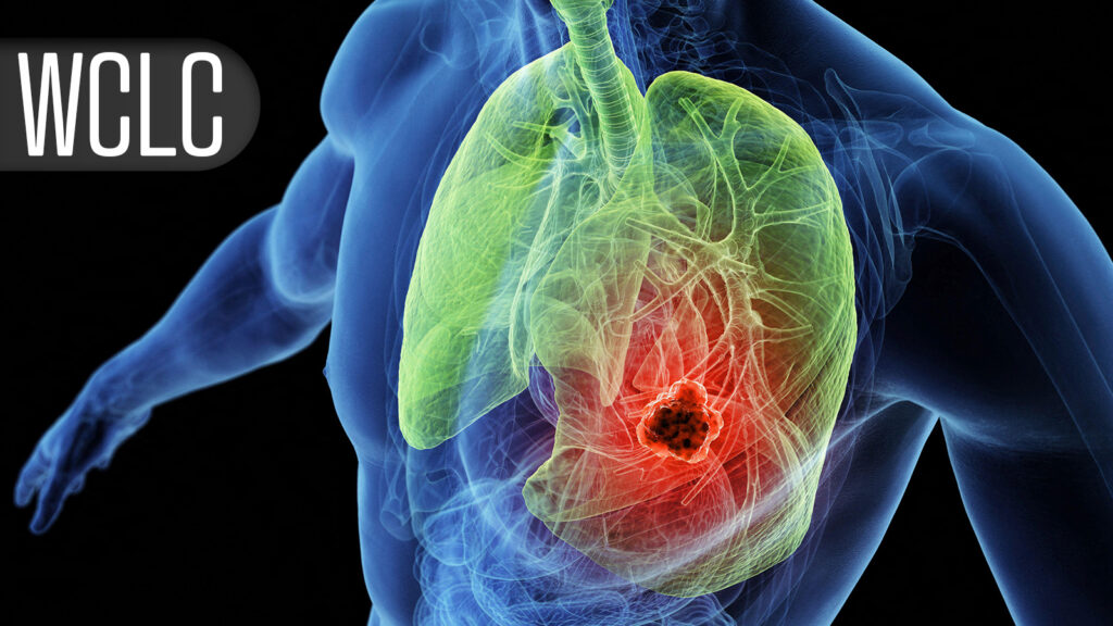 Drug Combo’s Response Rates Top 90% in Small Cell Lung Cancer Trial