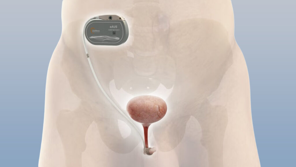 Remote-Controlled Urinary Sphincter Could Transform Incontinence Treatment for Men