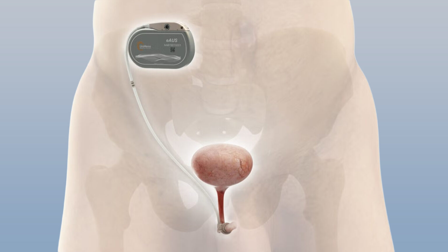Remote-Controlled Urinary Sphincter Could Transform Incontinence Treatment for Men