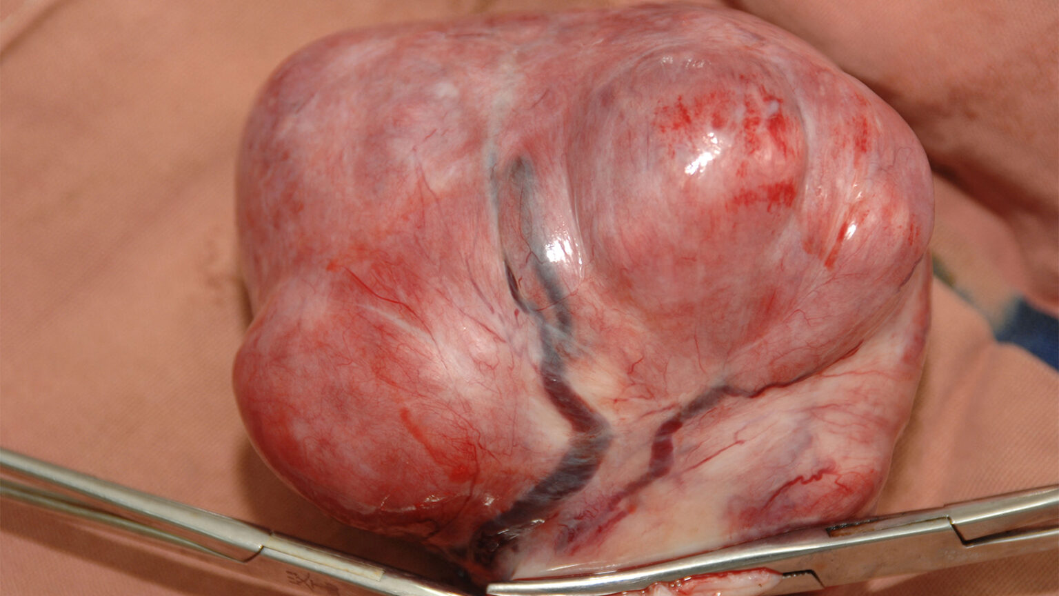Two Procedures May Yield Similar Symptom Relief for Uterine Fibroids