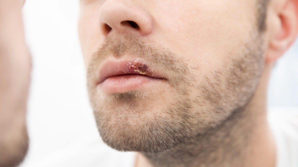 New Oral Drug Approved for Herpes Lesions