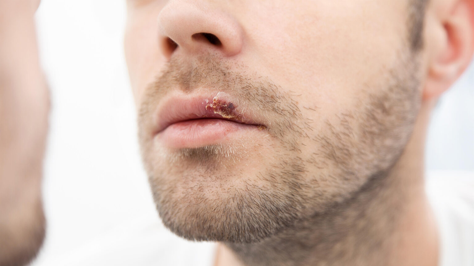 New Oral Drug Approved for Herpes Lesions