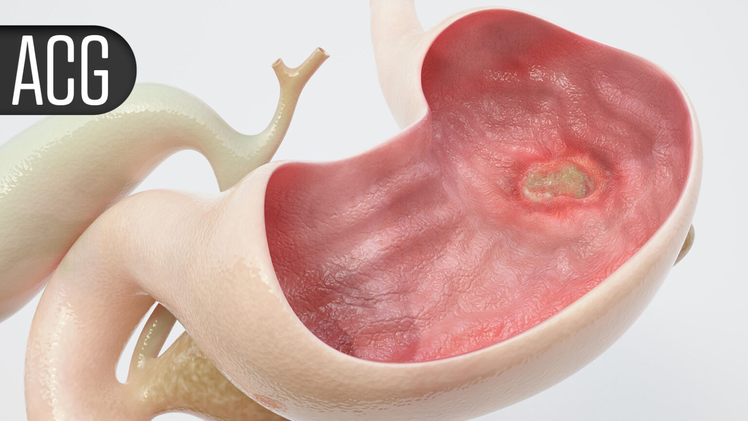 Assisted Reproductive Technology Effective in Women With IBD