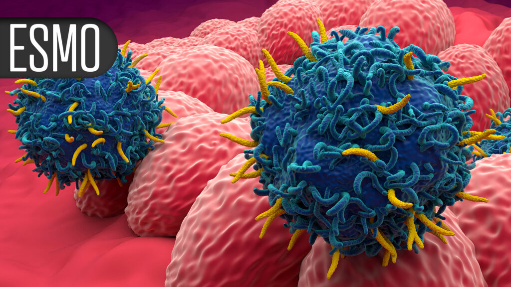 Novel ADC Achieves Impressive PFS Advantage in HER2-Low Metastatic Breast Cancer