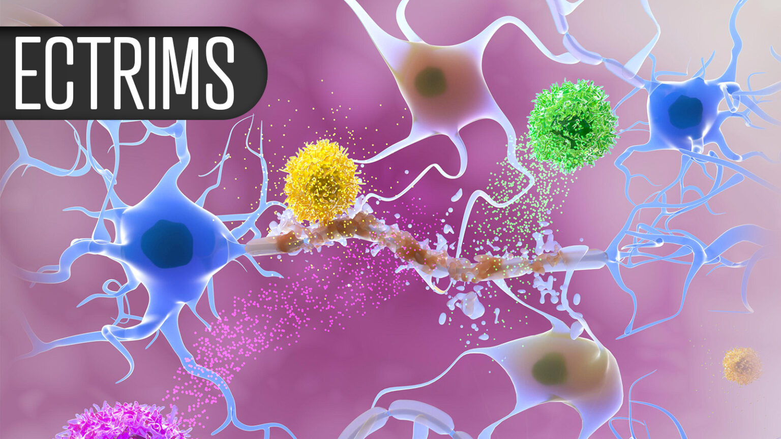 Patient Death Reported in Multiple Sclerosis CAR-T Study